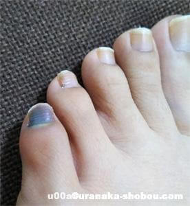 足の小指の爪